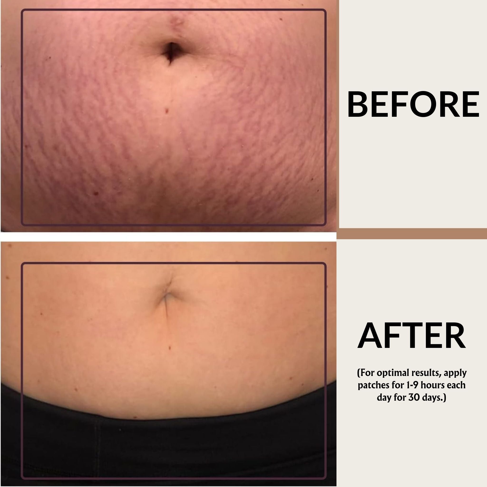 Silicone Anti Stretch Mark Stomach Patch